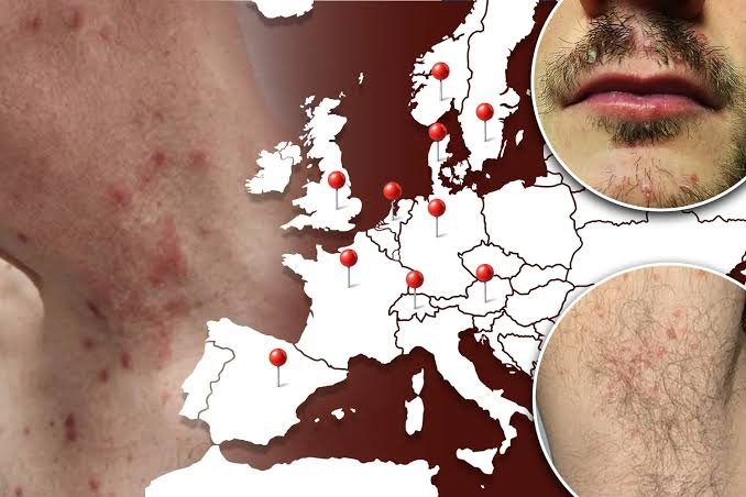 dermatophilus-congolensis-europe-human-cases-2026